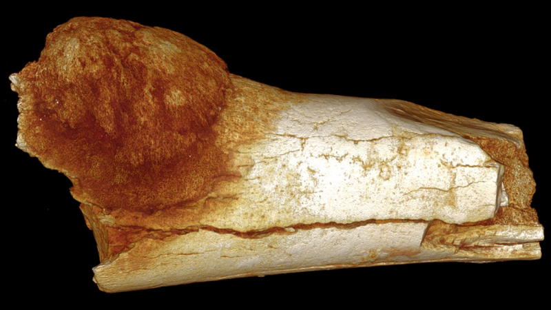 一塊屬於170 萬年前人亞族（hominin）的癌變腳骨。圖片來源：Edward J. Odes