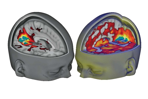 現在的掃瞄造影技術揭示 LSD 對於腦部的影響（圖片來源：Carhart-Harris et al.）