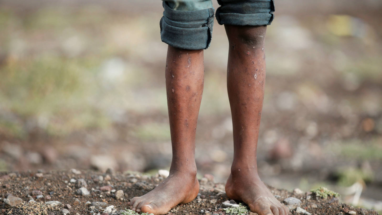 一名也門男孩患上皮膚病，令人心疼。圖片來源：路透社