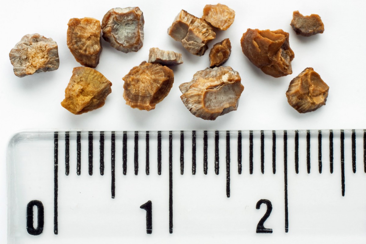 直徑 5 毫米以下的腎石多數可經尿液排出體外，體積過大則需手術震碎取出。
