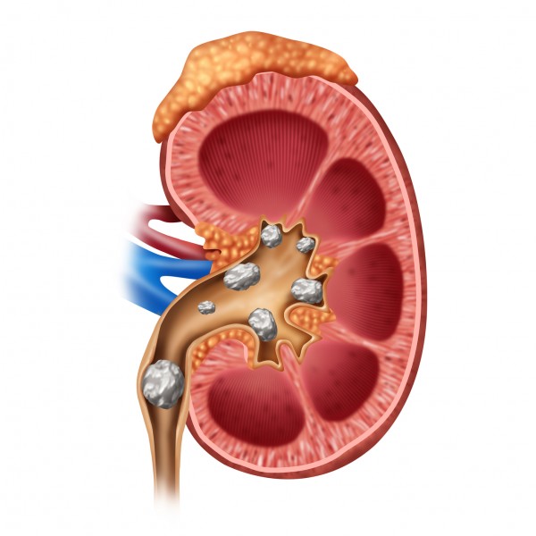 腎石假如堵塞輸尿管，將造成絞痛，痛如生仔。