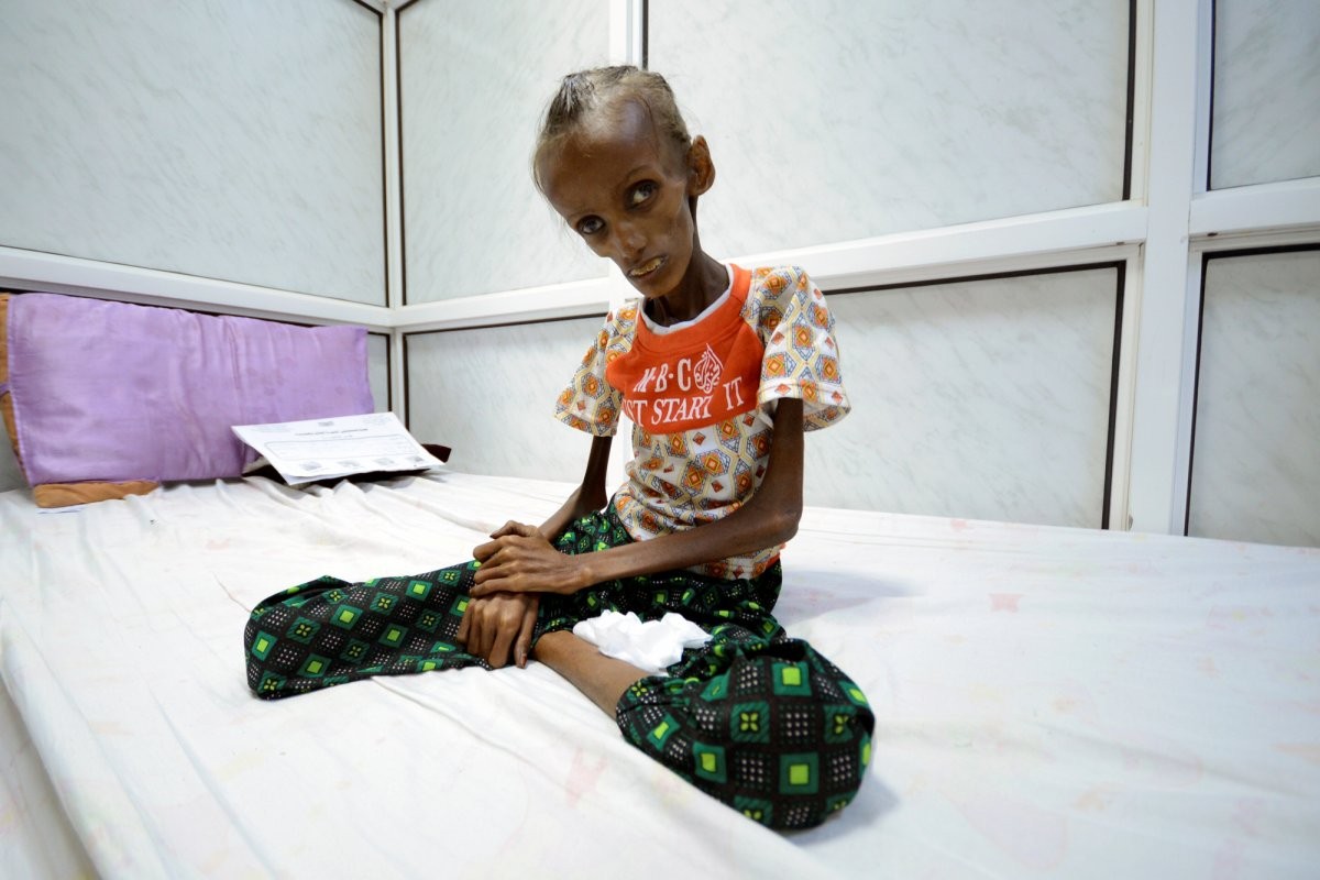 18-year-old-saida-ahmad-baghili-who-is-affected-by-severe-acute-malnutrition